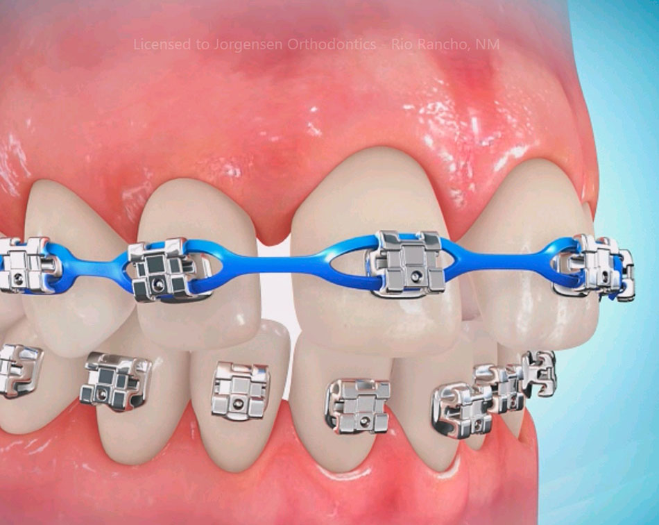 اررتودنسی راه حلی برای بستن فاصله دندان