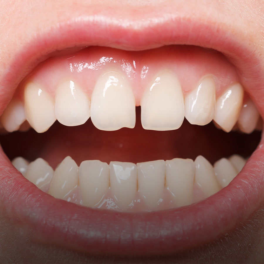 فاصله بین دندان ها 