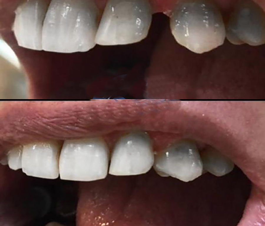 درمان فاصله دندان
