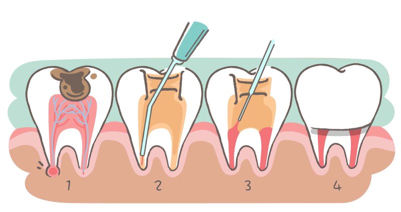مراحل عصب‌کشی دندان