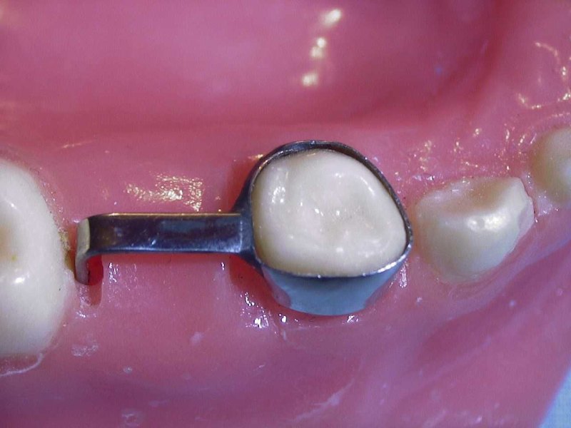 فضانگهدارنده دندان شیری