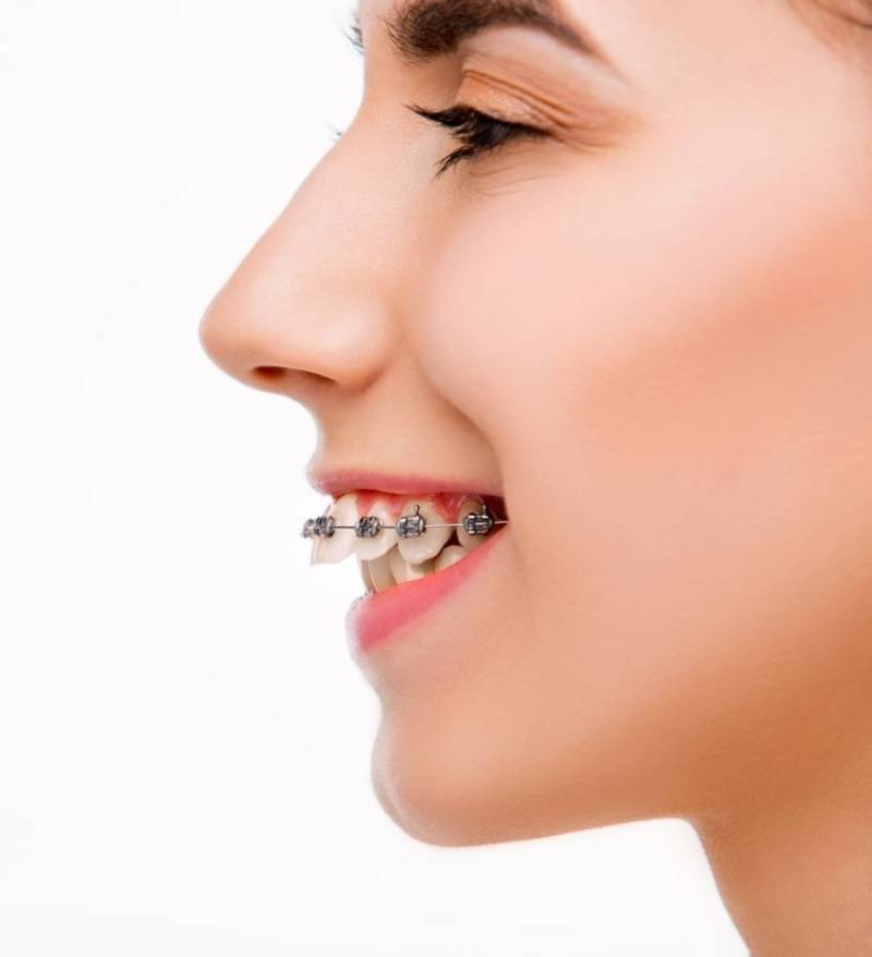 ارتودنسی و  اورجت دندان