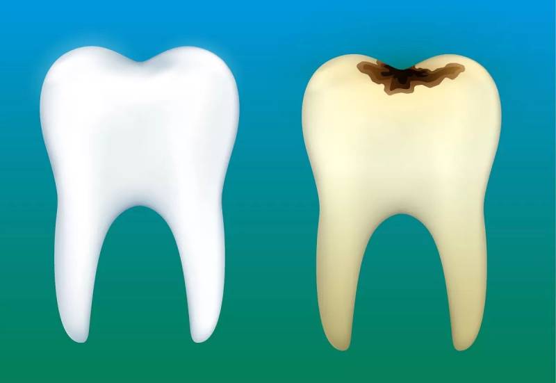 پوسیدگی دندان و جرم گیری دندان