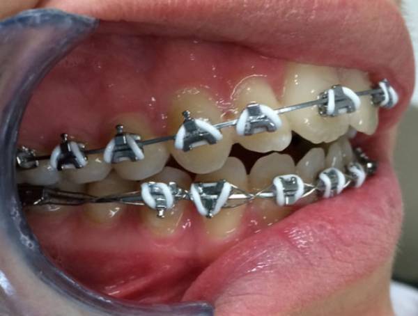 ارتودنسی سریع دندان
