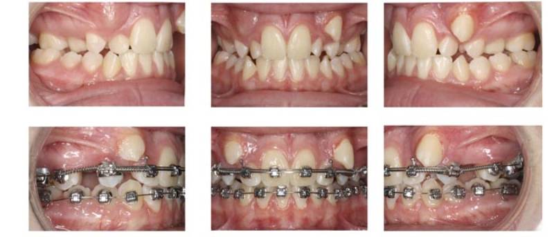 درمان شلوغی دندان