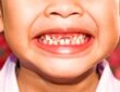 روکش دندان شیری کودکان