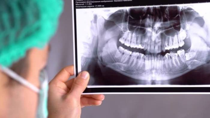 رادیوگرافی دندان