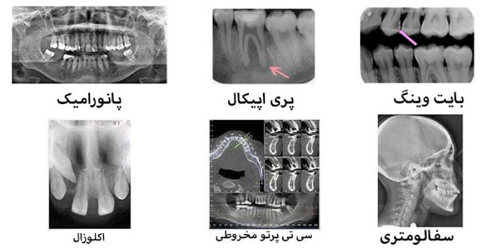 انواع رایدوگرافی دندان
