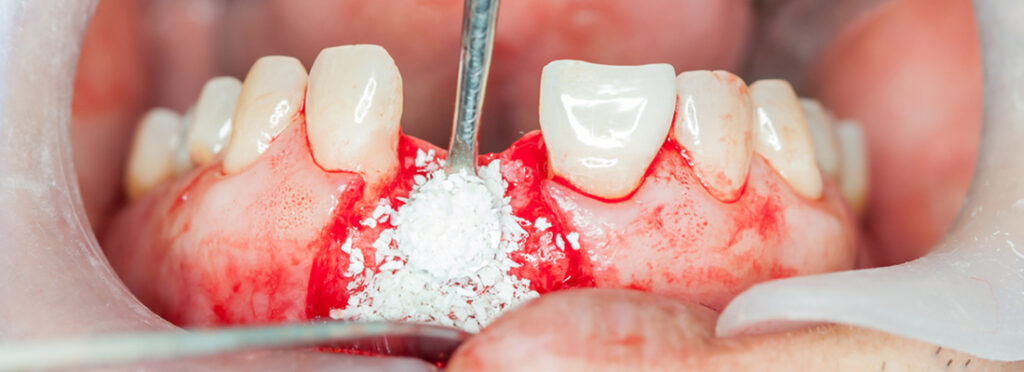 پیوند استخوان در ایمپلنت دندان 