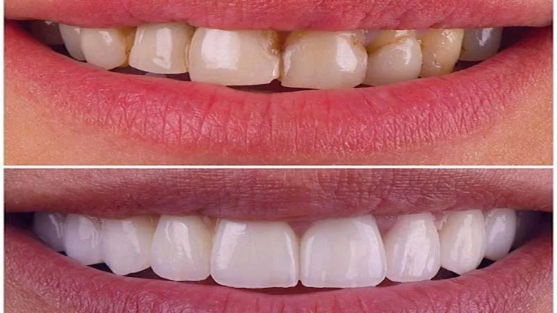 عوارض بعد از لمینت دندان