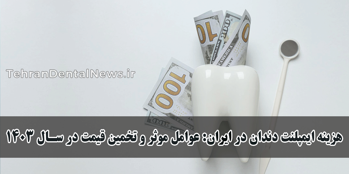 هزینه ایمپلنت دندان در ایران: عوامل موثر و تخمین قیمت در سال 1403