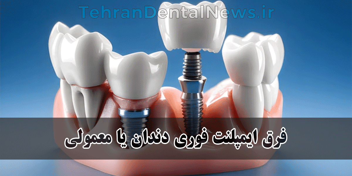 فرق ایمپلنت فوری دندان یا معمولی