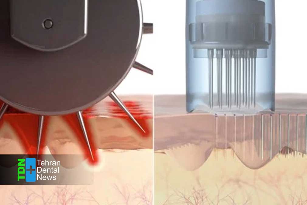 مکانیزم عملکرد میکرونیدلینگ