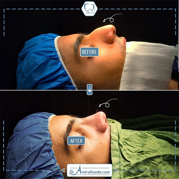 جراحی بینی حرفه ای