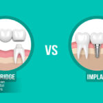 ایمپلنت دندان بهتر است یا بریج؟ بررسی علمی و مقایسه در سال 1404