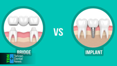 ایمپلنت دندان بهتر است یا بریج؟ بررسی علمی و مقایسه در سال 1404