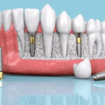 همه چیز درباره ایمپلنت دندان در اصفهان