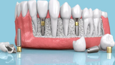 همه چیز درباره ایمپلنت دندان در اصفهان