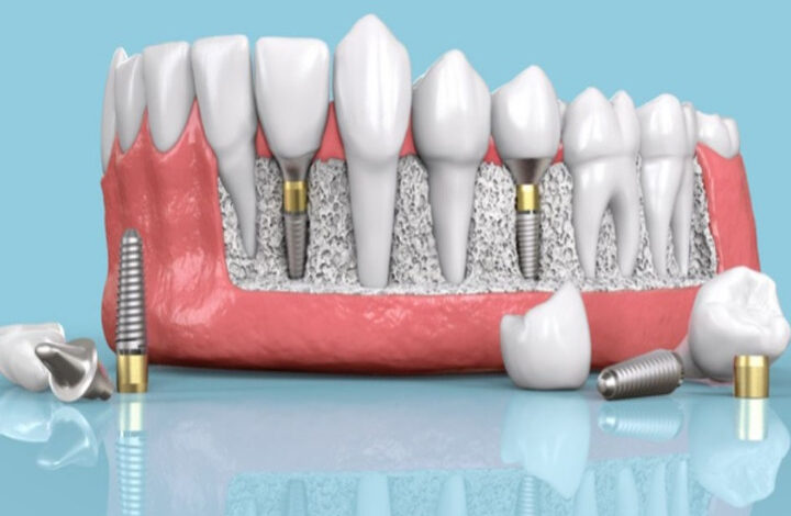 همه چیز درباره ایمپلنت دندان در اصفهان