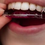 مراقبت های بعد از برداشتن ارتودنسی