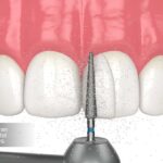 عوارض کامپوزیت ارزان چیست؟ چرا نباید همه چیز را فدای هزینه کمتر کرد و چه راه حلی داریم در 1404