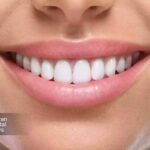 هزینه واقعی کامپوزیت دندان در تهران چقدر است؟ مقایسه قیمت بر اساس نوع مواد و برند در 1404