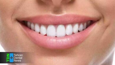 هزینه واقعی کامپوزیت دندان در تهران چقدر است؟ مقایسه قیمت بر اساس نوع مواد و برند در 1404