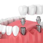 ایمپلنت دندان بهتر است یا بریج؟ مقایسه علمی مزایا هزینه و ماندگاری برای انتخاب درست در 1404