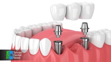 ایمپلنت دندان بهتر است یا بریج؟ مقایسه علمی مزایا هزینه و ماندگاری برای انتخاب درست در 1404