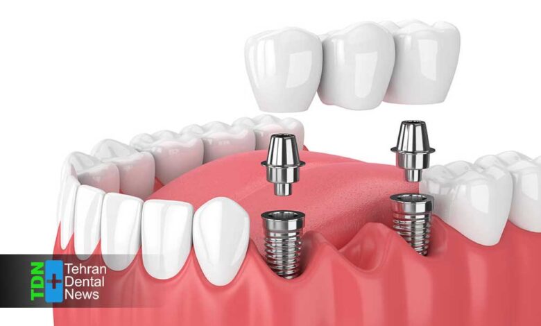 ایمپلنت دندان بهتر است یا بریج؟ مقایسه علمی مزایا هزینه و ماندگاری برای انتخاب درست در 1404