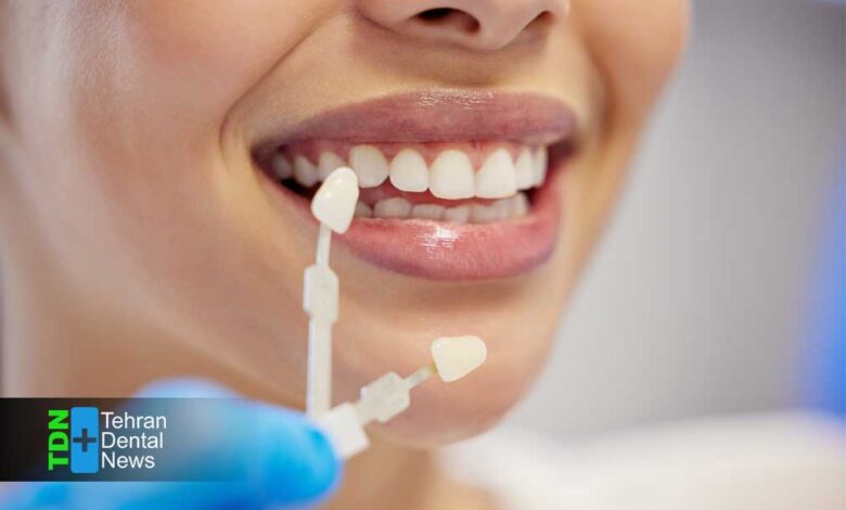 اشتباهات رایج مراقبت از لمینت دندان که باعث آسیب و کاهش عمر آن می شوند و راهکارهای جلوگیری از آنها