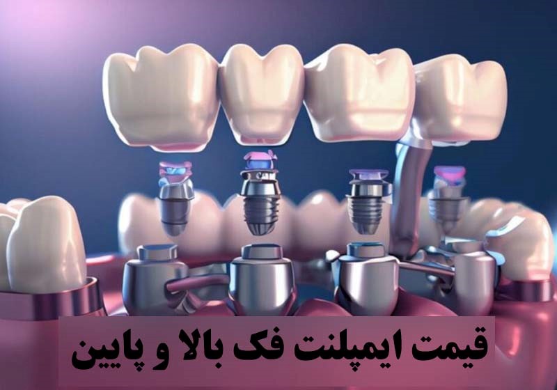 قیمت ایمپلنت فک بالا و پایین