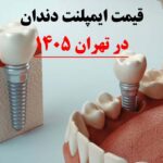قیمت ایمپلنت دندان در تهران
