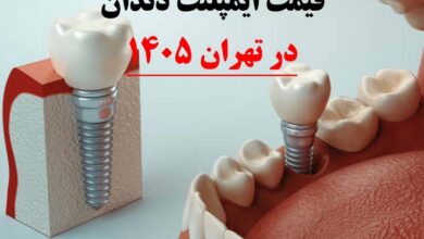 قیمت ایمپلنت دندان در تهران