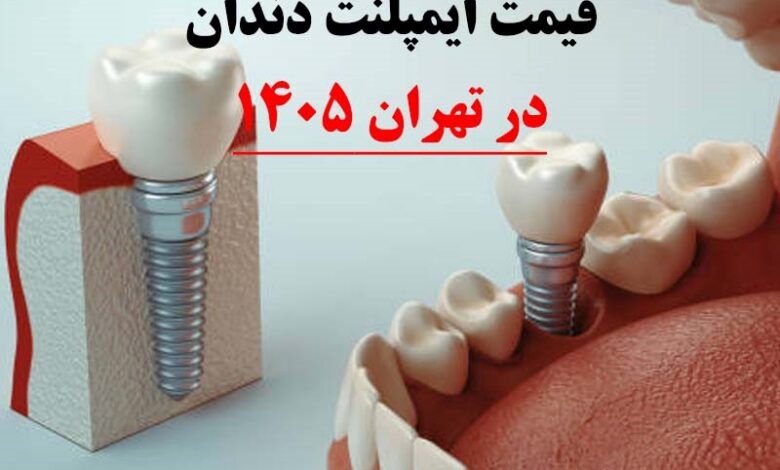 قیمت ایمپلنت دندان در تهران