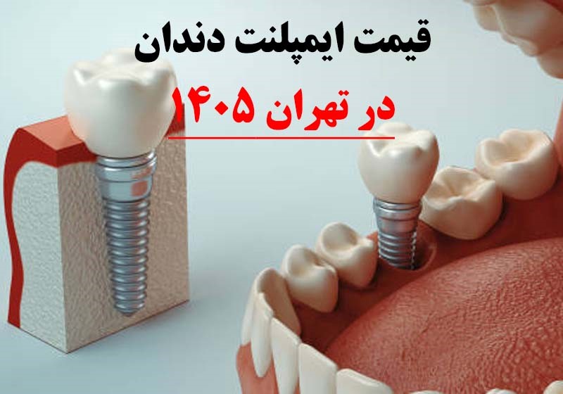 قیمت ایمپلنت دندان در تهران