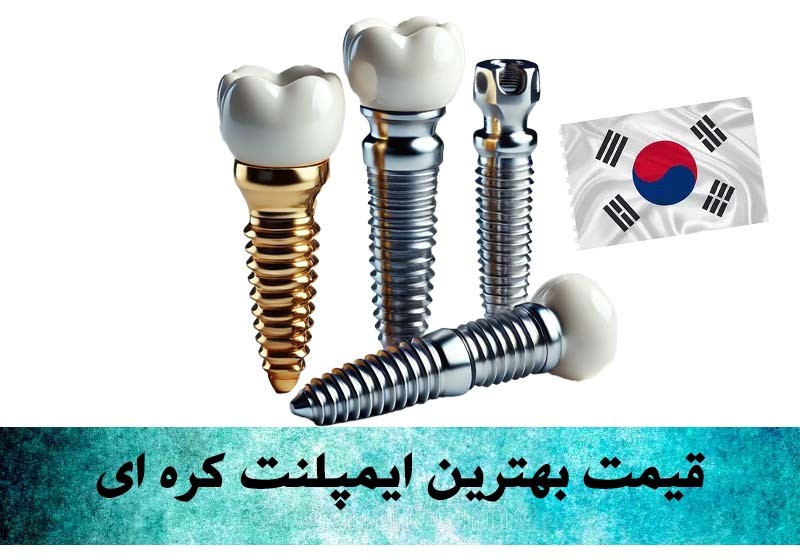 قیمت بهترین ایمپلنت کره ای در تهران